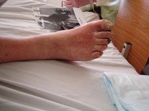 Legs of a man with some disease side effect